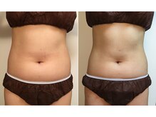 ファロンビューティー(fallon beauty)/痩身ビフォーアフター