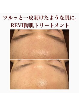 心斎橋 ルヴィ(REVI)/ハーブピーリングの変化