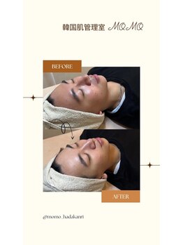 モモ(momo)/男性も肌管理をする時代♪