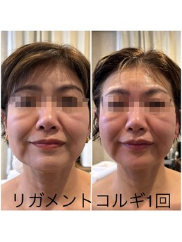 ケイビューティーサロン(K BeautySalon)/リガメント小顔コルギ！！