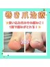 【切らない巻き爪施術で一発改善！】巻き爪（爪1本）￥13,200→7,700円　