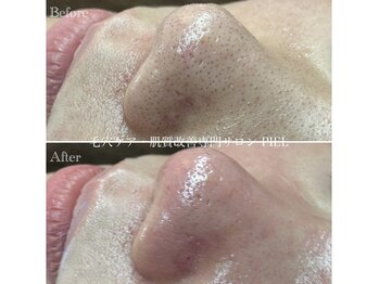 ピエル 北千住店(PIEL)/回数を重ねるごとに