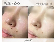 スリースリー(THREE THREE)/乾燥・赤みケア