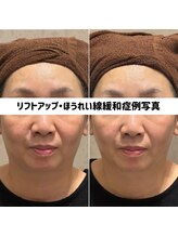 リジェ(Rege)/50代女性の方　施術