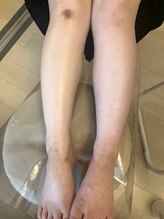 ミント/左右の足のリンパ後、リンパ前