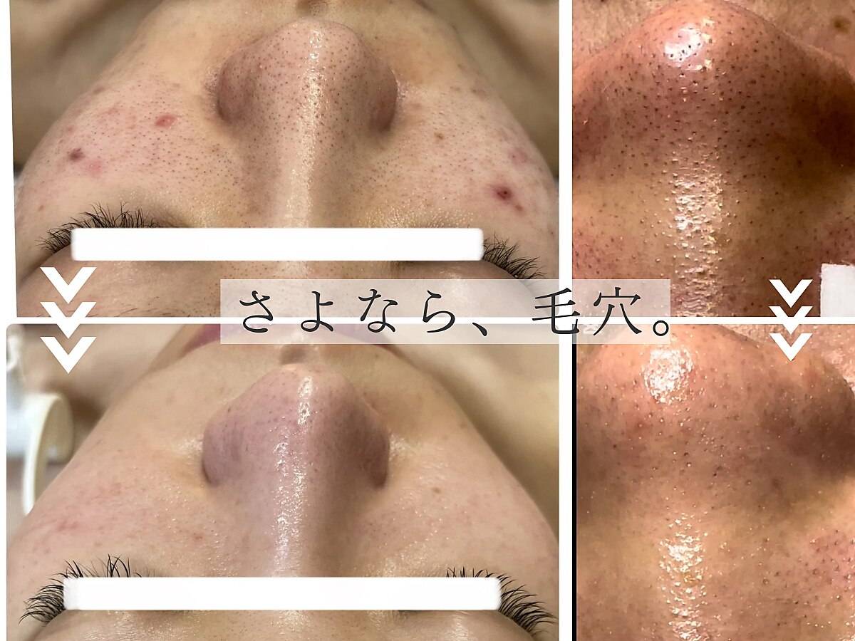 大津市で毛穴洗浄・毛穴吸引が人気のエステサロン｜ホットペッパー