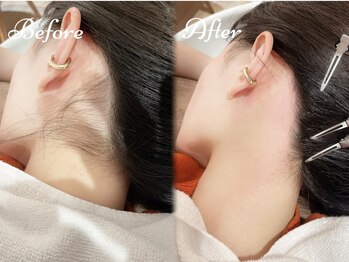 ピミル(PIMIL)/うなじ脱毛