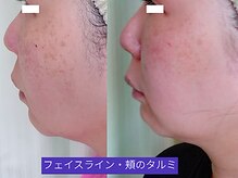 ソフィームの雰囲気（頬のタルミと顎悩み月に一度のケアです。）