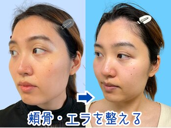 ナチュラルパーフェクトフェイス 新宿/歪みを整えた顔/新宿駅小顔矯正