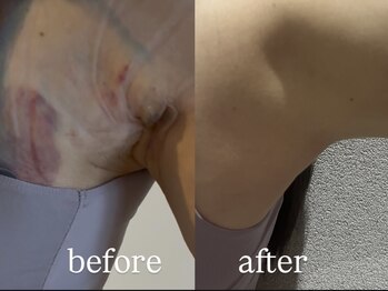 術後インディバ専門サロン 新宿/二の腕/脇/術後インディバ