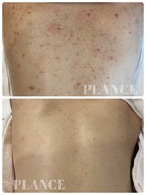 プランス 熊本(PLANCE)/背中ニキビケアもお任せ！