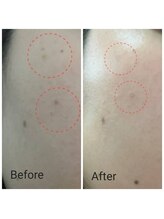 サロン ピューパ(Salon pupa)/女性頬シミケア　before→after