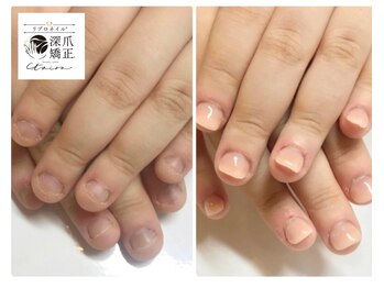 トイロ(toiro)/深爪以外の爪悩みも解決♪