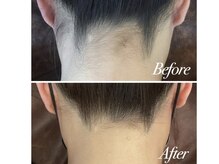 サロン ロワ(Salon Rowa)/最新で最高級の脱毛機器導入！