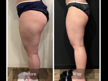 グラシアス サロン(GRACIAS SALON)/人気NO1ガッツリ痩身エステ