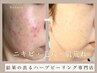 新規限定ハーブピーリング【フェイシャル】毛穴改善★初回120分¥9600