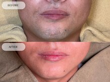 メンズプラス(MEN’S PLUS)/ヒゲ脱毛/ビフォーアフター写真