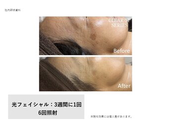 エクラルム(Eclaleum)/BeforeAfter　光フェイシャル
