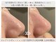 ミエル 神戸店(Miel)の写真/毛穴洗浄だけで満足？その後の導入ケアで肌は変わる。肌内部にまで美容成分をたっぷり導入し潤い溢れる肌へ