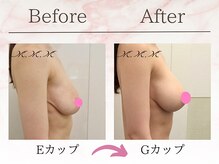 エムエムエム 表参道Luxeサロン(M.M.M)/【バストアップ例】　E→Gカップ
