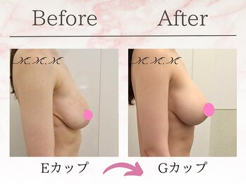 エムエムエム 表参道Luxeサロン(M.M.M)/【バストアップ例】　E→Gカップ