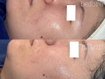 ロイ 初生店(LOI)/ハーブ×プラズマ　セット