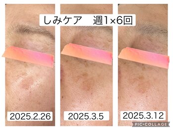 リセル(Recell)/本気のしみ改善