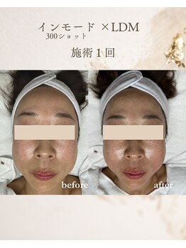 フォルディオ(FORDIO)/インモード半顔×LDM