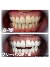 ホワイトニングサロン 京都烏丸店/ホワイトニング施術例