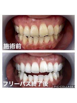 ホワイトニングサロン 京都烏丸店/ホワイトニング施術例