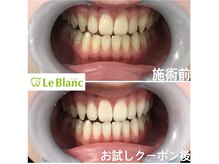 ルブラン 奈良店(Le Blanc)/白い歯は当たり前！