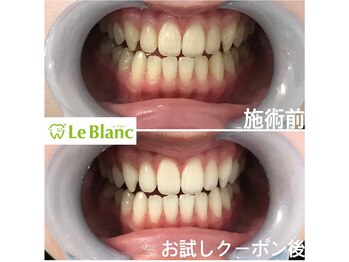 ルブラン 奈良店(Le Blanc)/白い歯は当たり前！