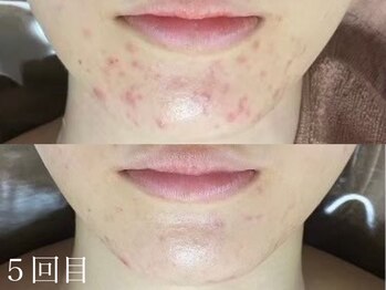 アワピール 天王寺店(AWA PEELL)/ハーブピーリング/ニキビケア