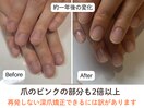 「自爪育成」「自爪再生」が叶う