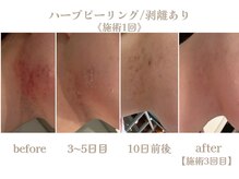 アムールドゥ 麻布十番(Amour deux)/ハーブピーリング