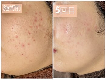 おうちサロン ミキ/毛穴が目立つ凹凸が劇的変化
