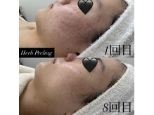サロン ド アン(salon de An)の雰囲気（ワックス脱毛＋光脱毛メニュー！5倍の効果）