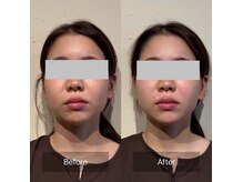 菫鍼灸院の雰囲気（頭皮鍼付き全顔美容鍼で、左右差やたるみを改善します）