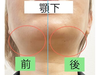 みつばちさろん/【ブラックスタンプ】顎下