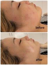 マーキュリー(Mercury)/ハーブピーリングのお客様