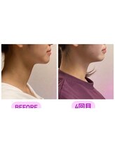 小顔22 ボルティ 本店(Bolty)/【悩み】面長