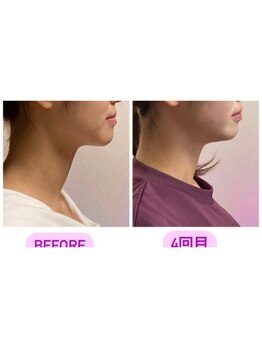 小顔22 ボルティ 本店(Bolty)/【悩み】面長