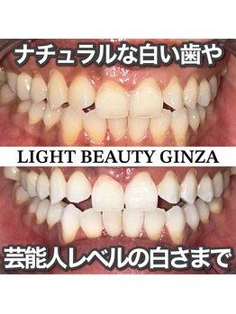 ライトビューティー 銀座店(LightBeauty)/東銀座 ホワイトニング症例写真