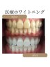 医療提携ホワイトニングご希望の方☆カウンセリング☆確実に白くにしたい方