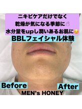 ハニーアイズ(Honey Eyes)/【BBLフェイシャル体験】
