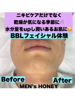 ハニーアイズ(Honey Eyes)/【BBLフェイシャル体験】