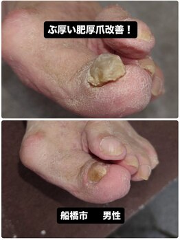 巻き爪じゅん 千葉駅前店/肥厚爪と変色を改善！