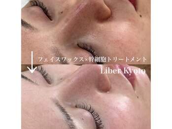 リベルキョウト 京都駅前店(Liber Kyoto)/艶美白!レチノール/幹細胞パック
