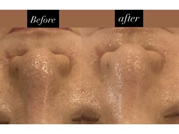 アミティエ 恵比寿駅前店(Amitie)/【施術症例】顔脱毛×毛穴洗浄