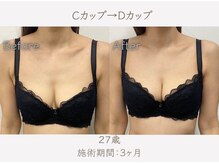 ハリスタ 京橋院(HARISTA)/BEFORE AFTER【バストアップ】